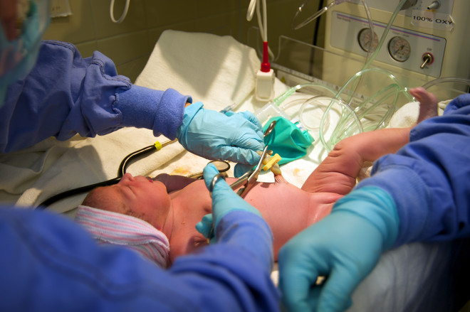 Nabelschnur bei einem Neugeborenen