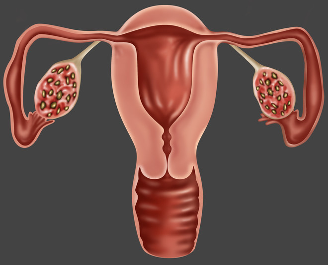 Terhesség policisztás petefészekben