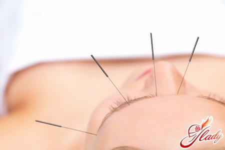Akupunktur von stimulierenden Punkten