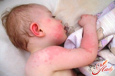 אלרגיה בטיפול בילודים