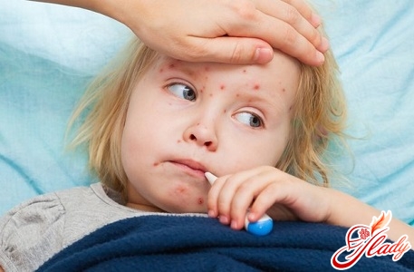 symptoms of whooping cough