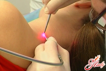 papilloma removal on the neck by laser
