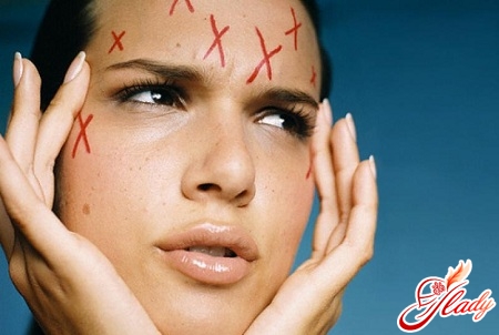 anti-acne remedy