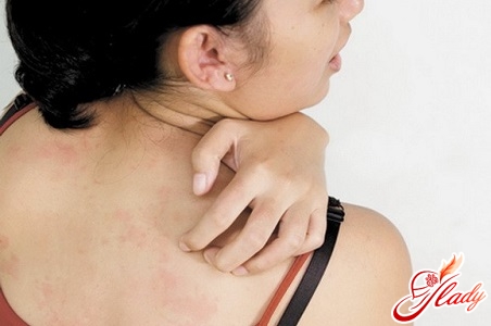scabies on the body