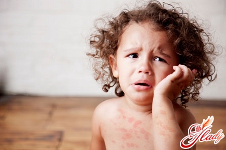 measles in children
